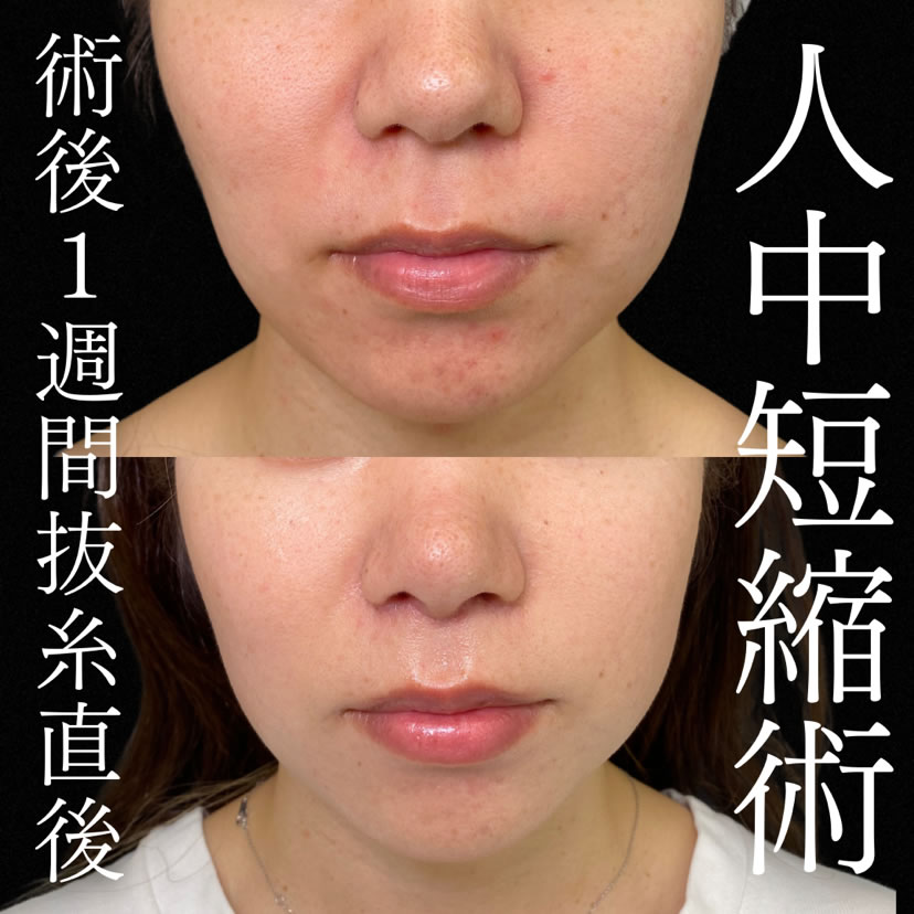 一週間後の抜糸直後の人中短縮手術の札幌院の症例