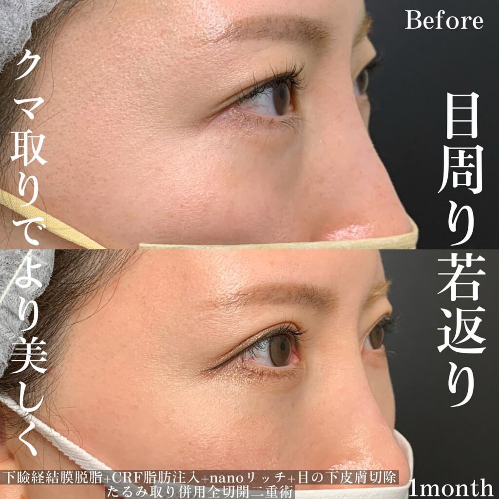 脱脂 脂肪注入 たるみ取り 全切開