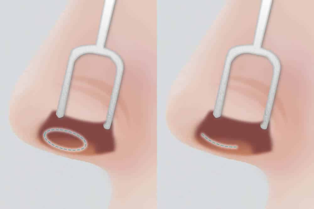 鼻柱挙上術の図解