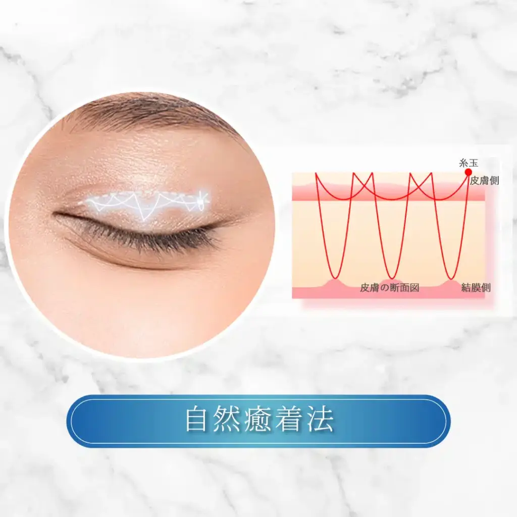 自然癒着法のイメージ