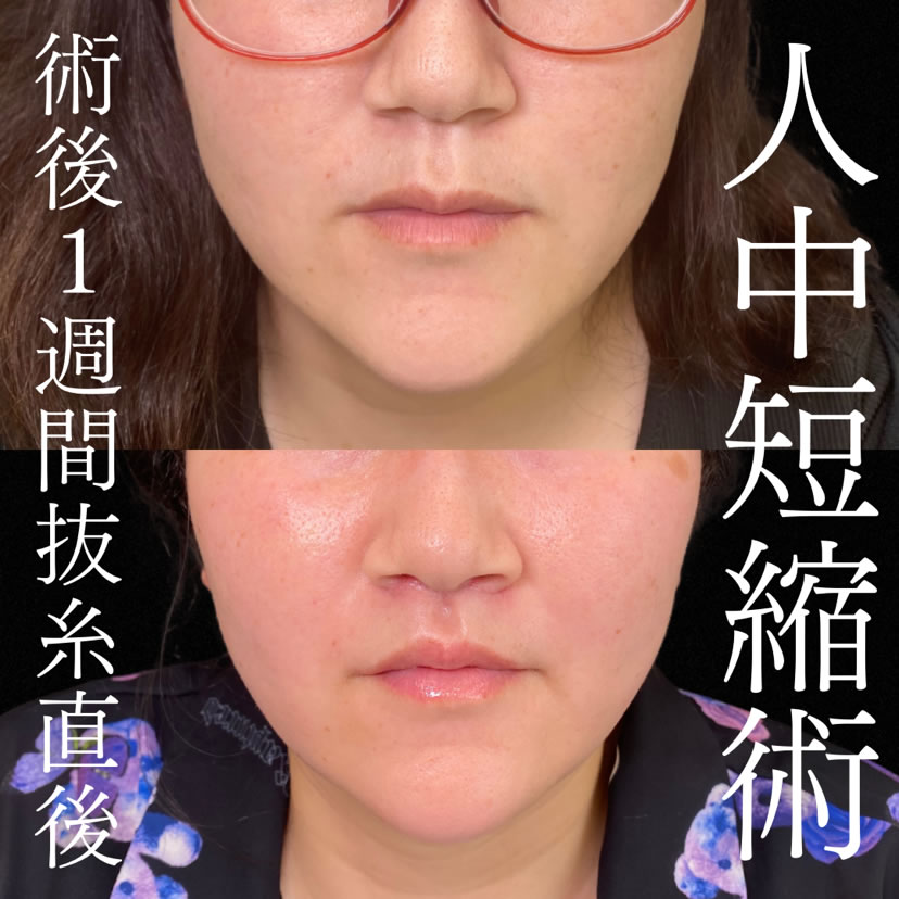 札幌院の人中短縮直後の症例写真