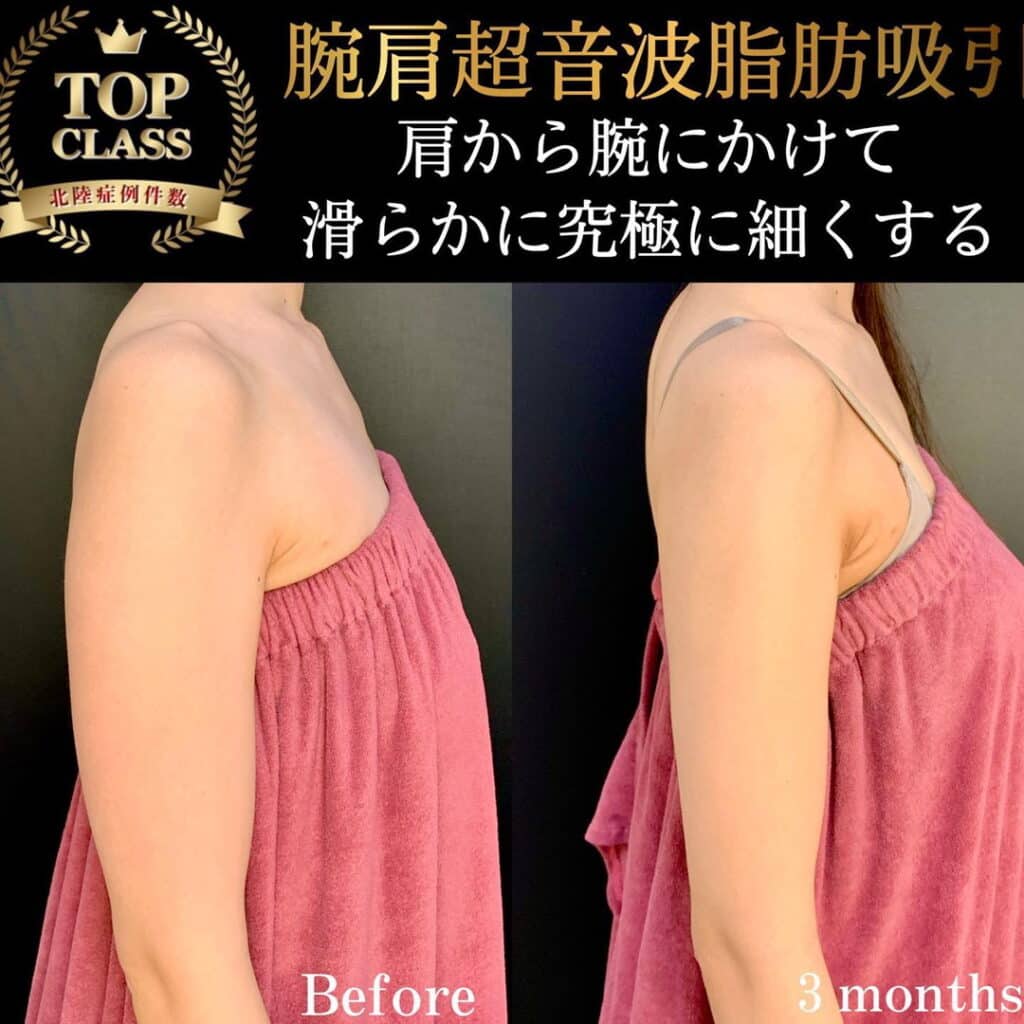eclinic札幌院の腕脂肪吸引の症例写真