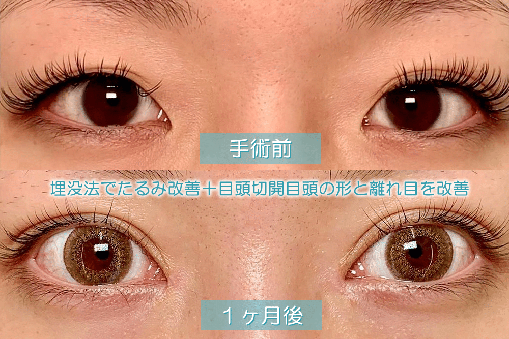目頭切開の症例写真