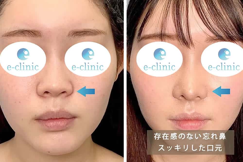 貴族手術の症例写真1