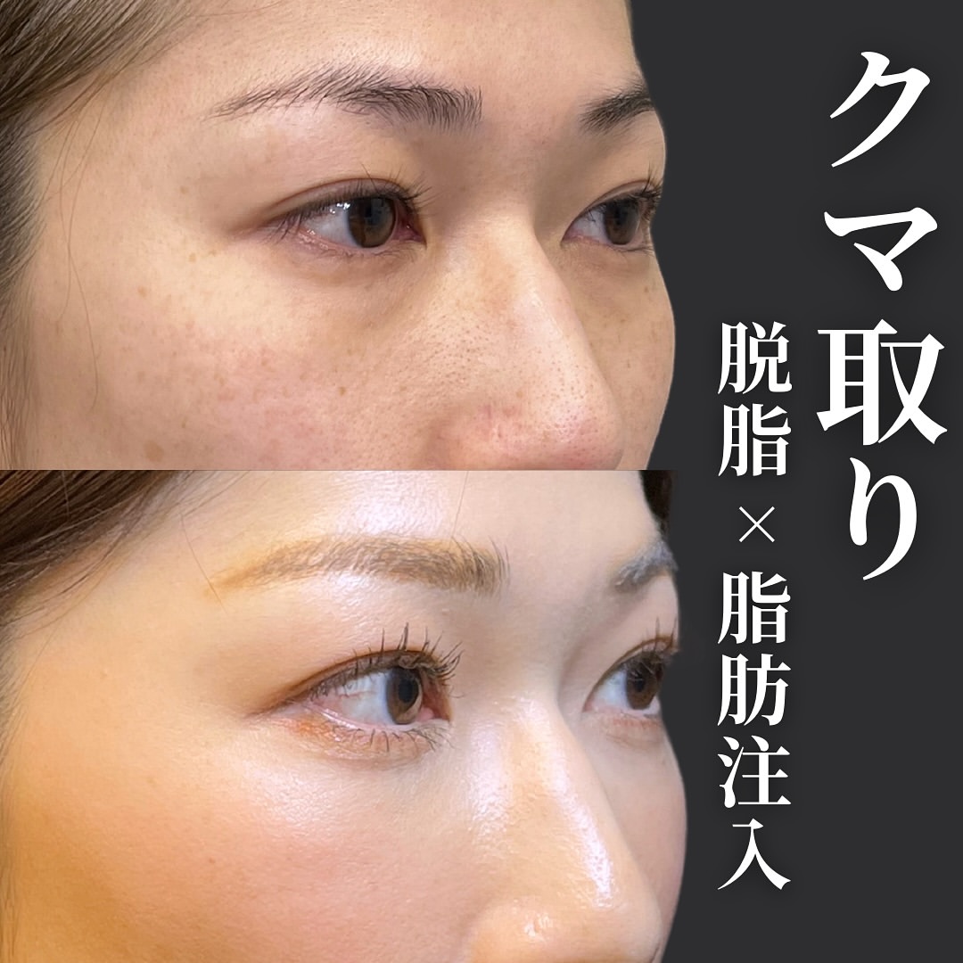 脱脂と脂肪注入の症例写真 (12)