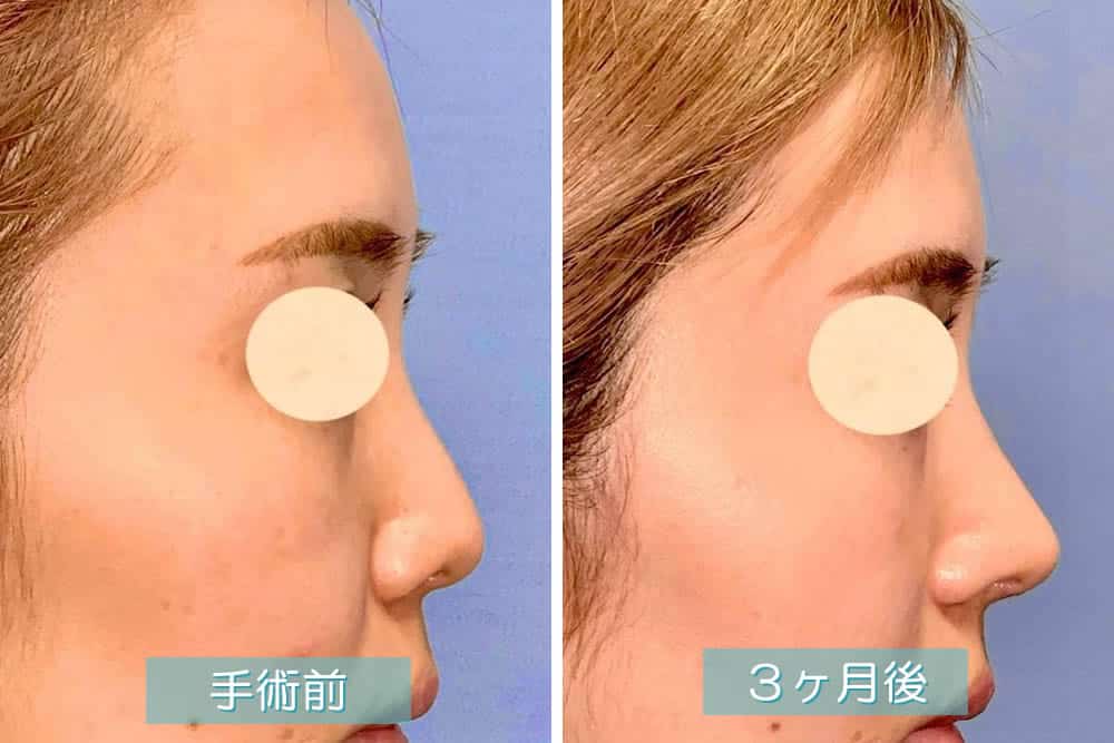 鼻尖部軟骨移植の３ヶ月後の症例