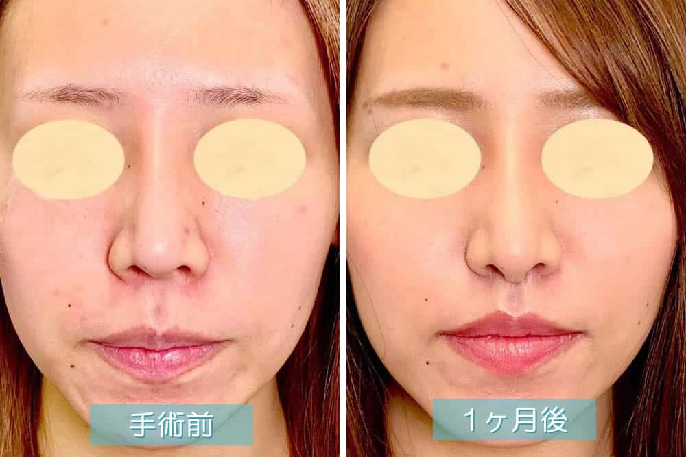 １ヶ月後の鼻唇角形成術・鼻柱下降術・猫手術の症例