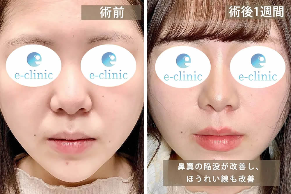 貴族手術の症例写真２