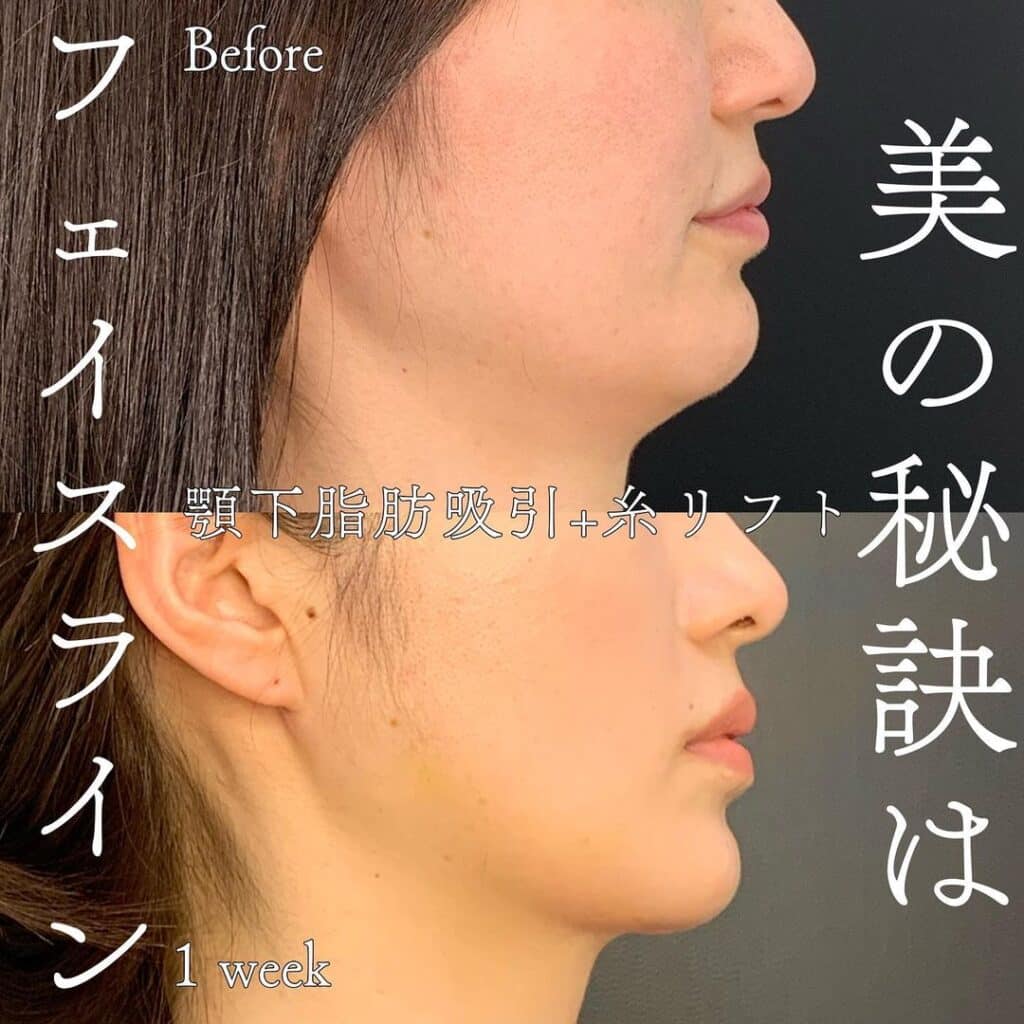 顎下の脂肪吸引の症例