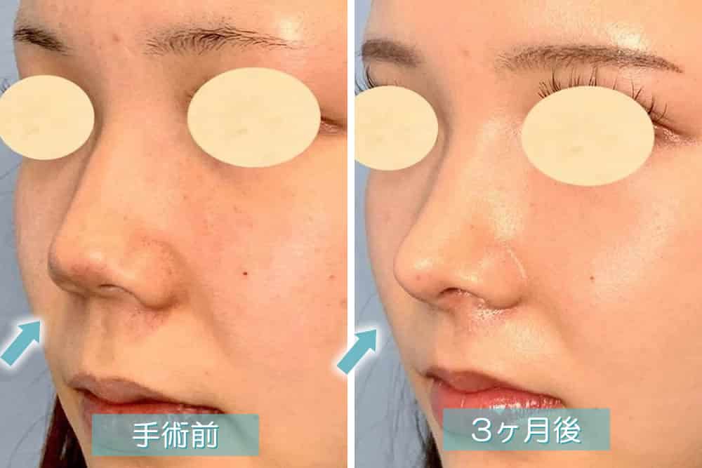 斜めから見た3ヶ月後の鼻唇角形成術・鼻柱下降術・猫手術の症例