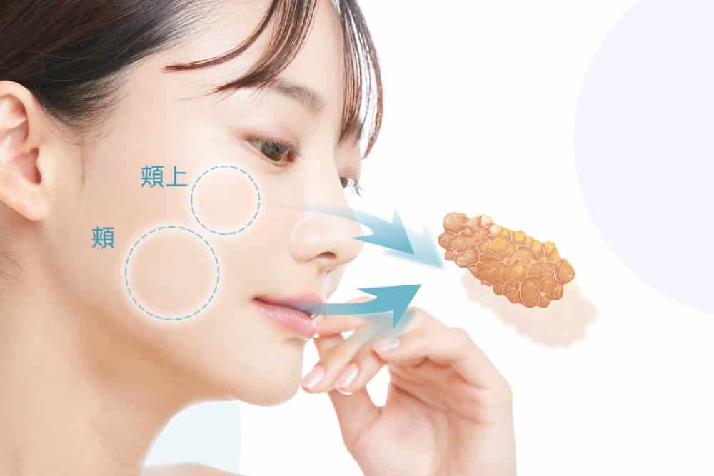 頬の脂肪吸引の図解