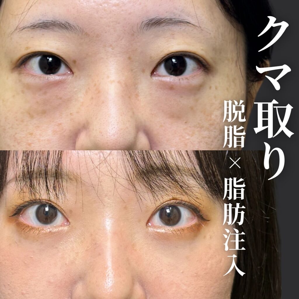 脱脂と脂肪注入の症例写真 (9)