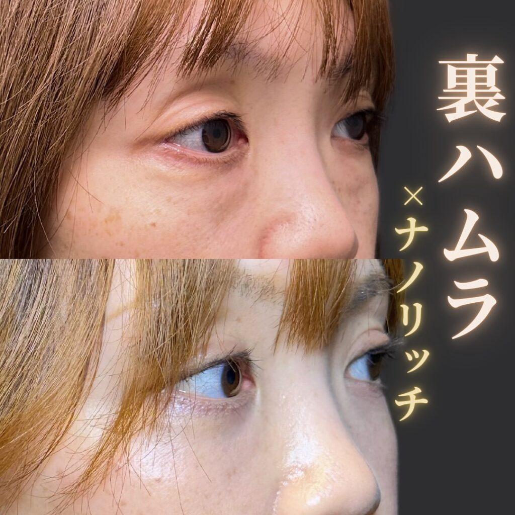裏ハムラ法とナノリッチの症例写真 (6)