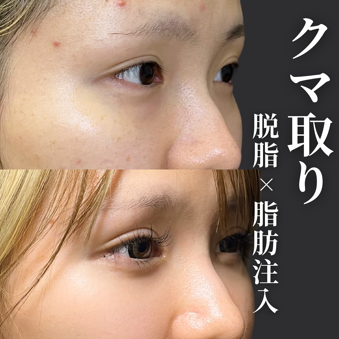 脱脂と脂肪注入の症例写真 (11)