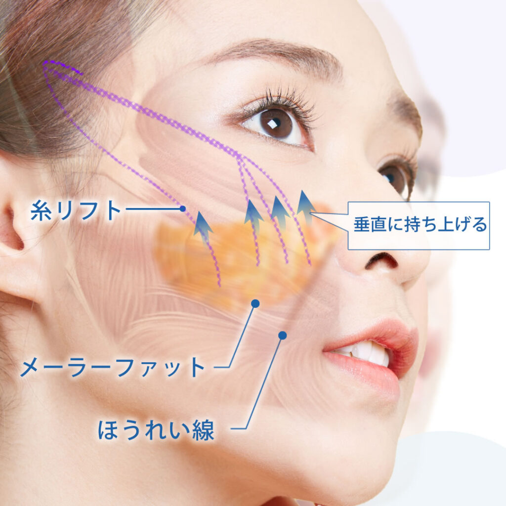バーティカルリフトの図解