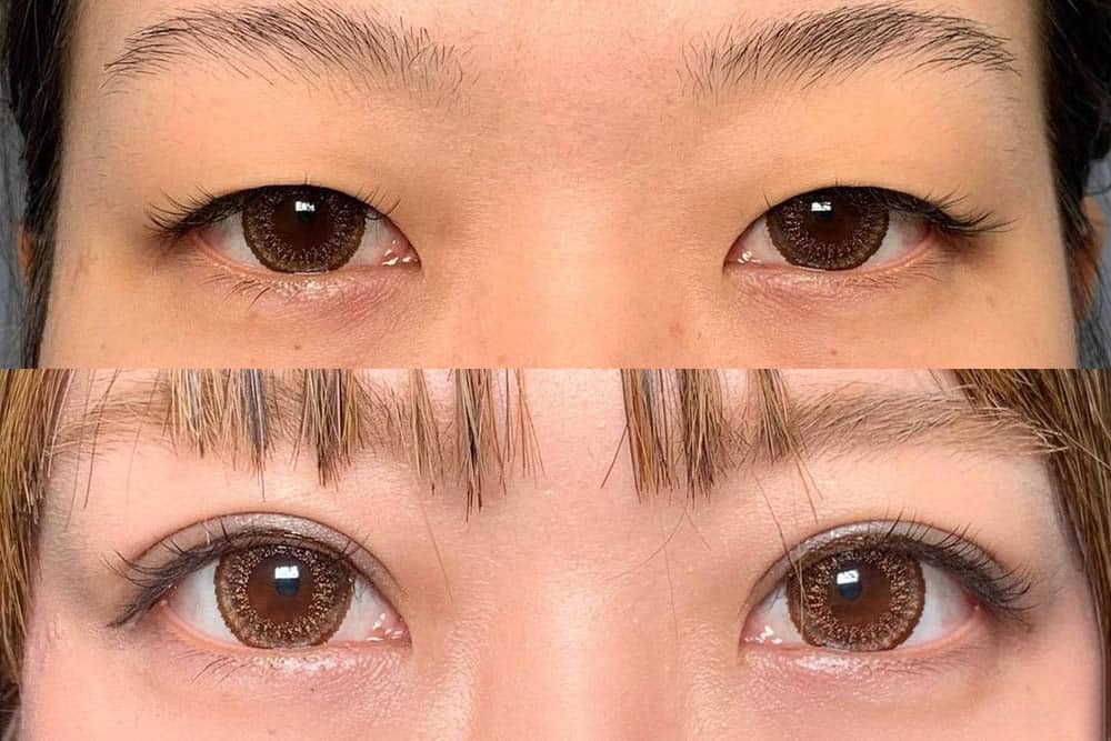 埋没法の症例