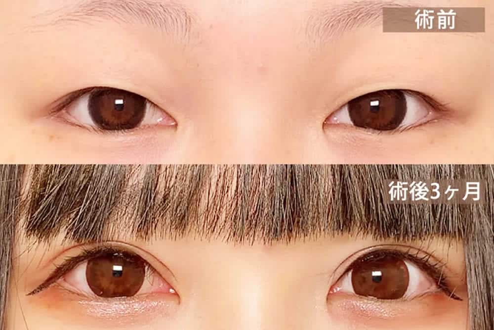 全切開の症例写真