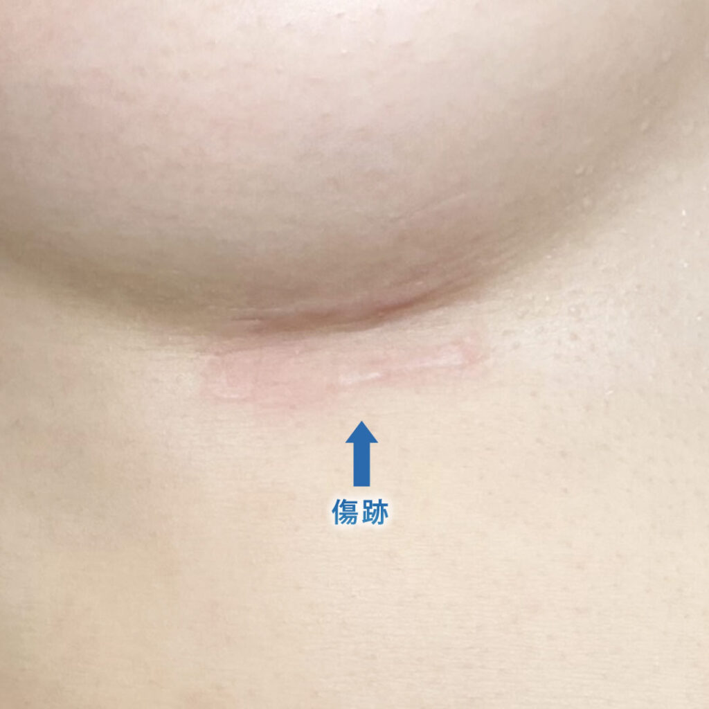 ６ヶ月後の肋軟骨の傷跡