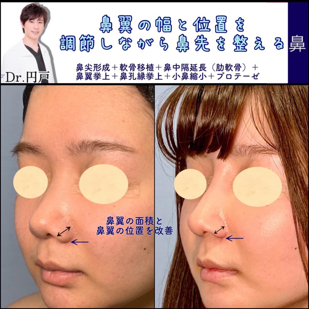 鼻尖形成と軟骨移植と鼻中隔延長と鼻翼挙上と鼻孔縁挙上と小鼻縮小とプロテーゼの症例写真 (1)