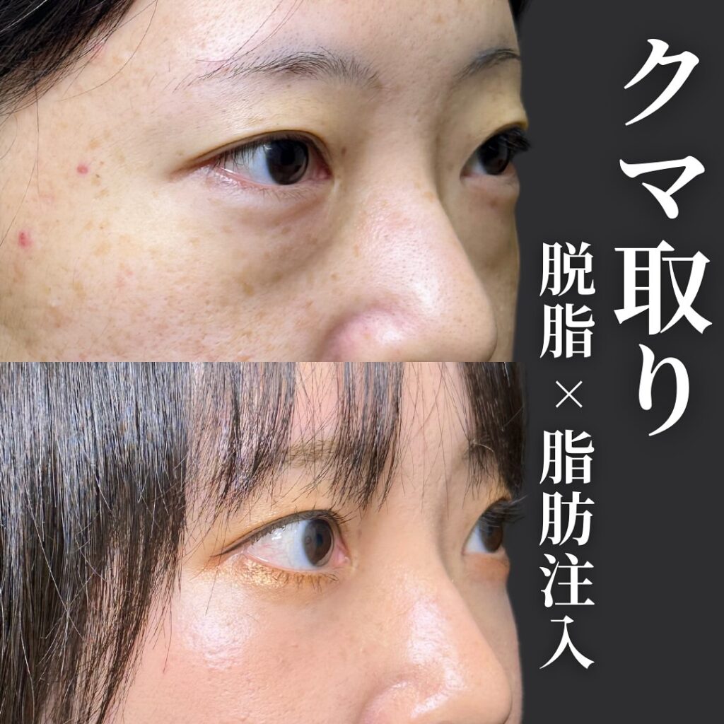 脱脂と脂肪注入の症例写真 (10)