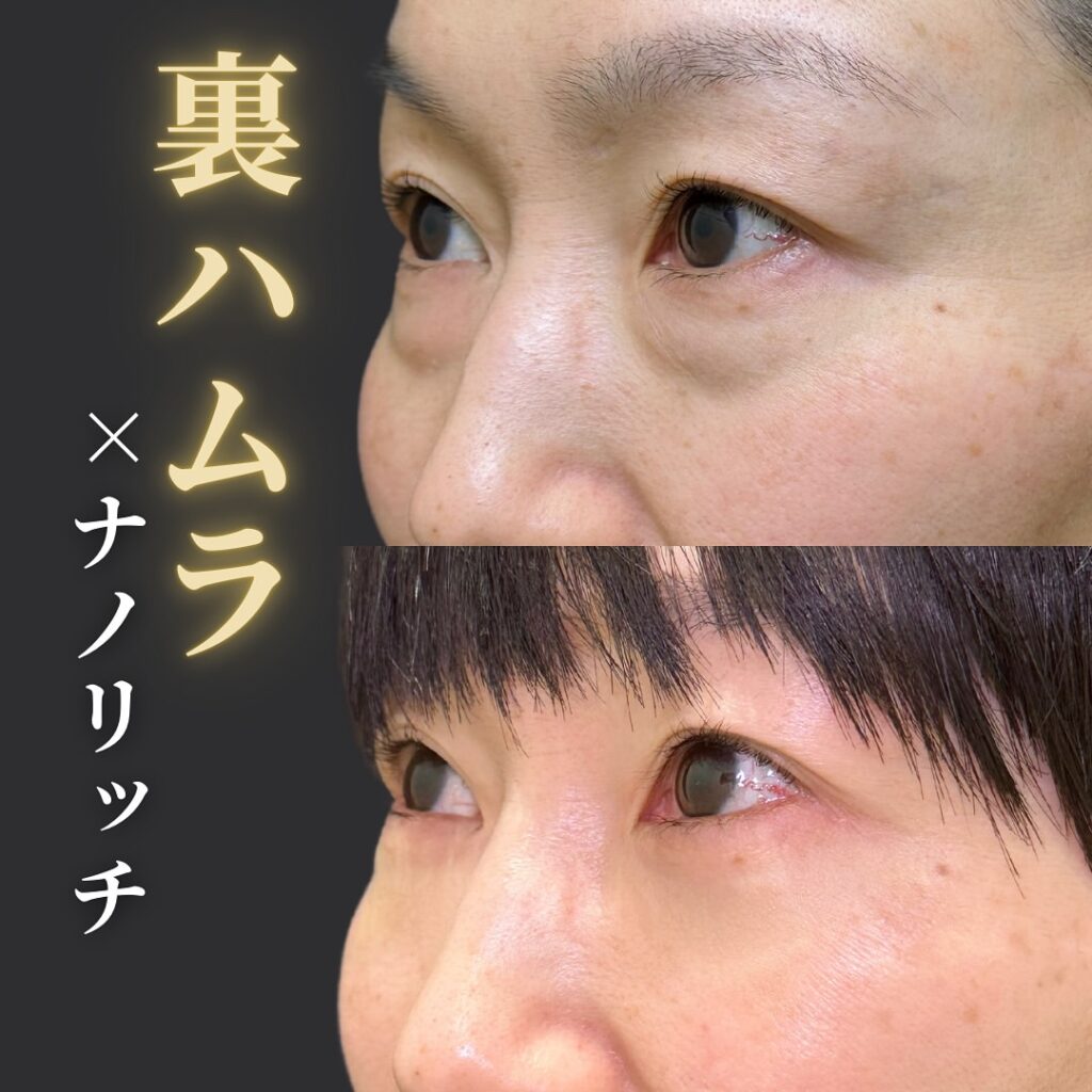 裏ハムラ法とナノリッチの症例写真 (16)