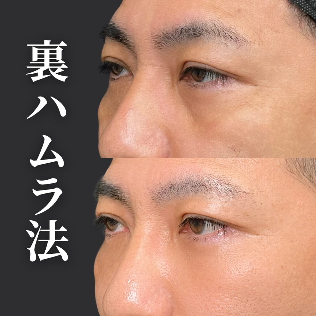 裏ハムラ法の症例写真 (57)