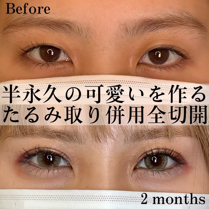 たるみ取り全切開