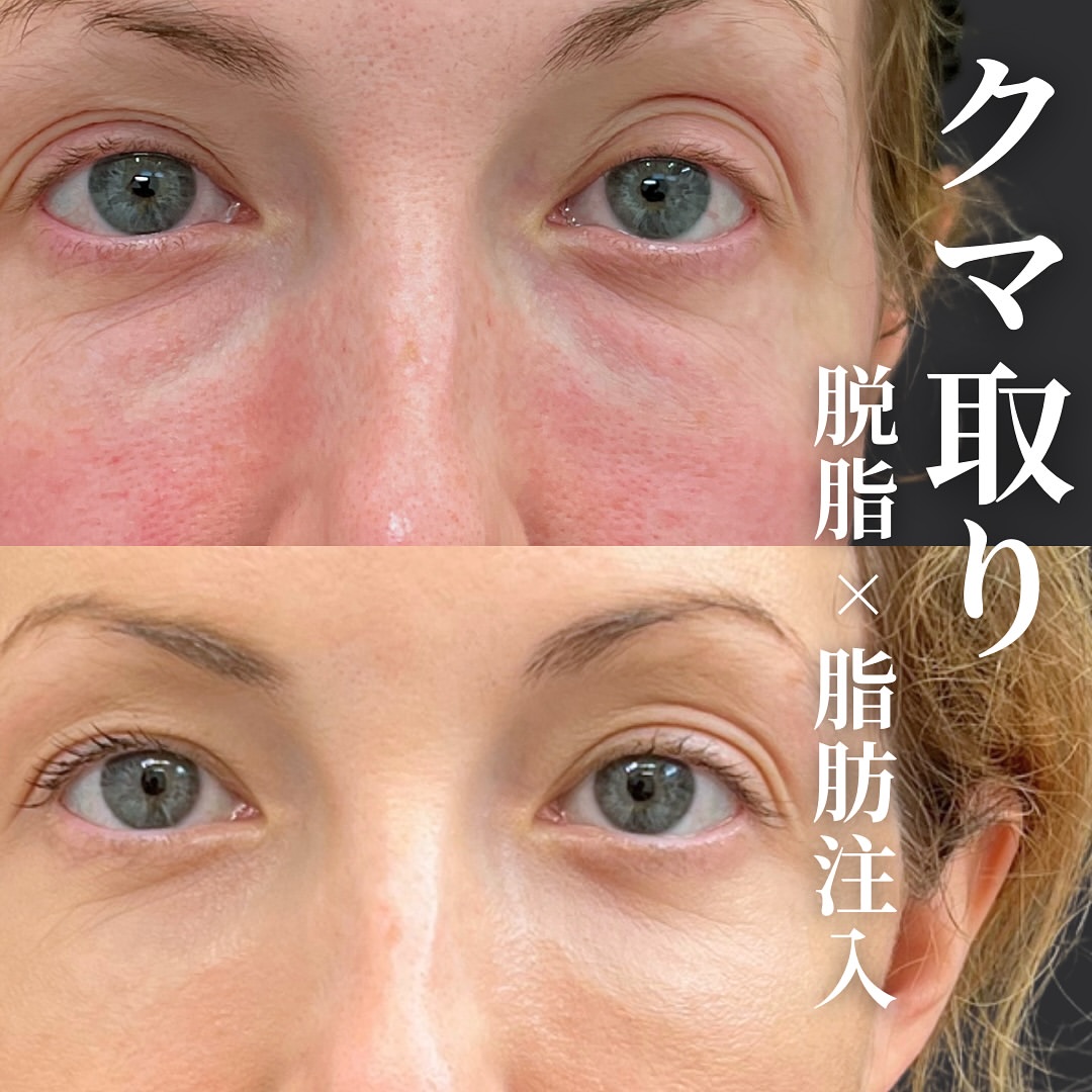 脱脂と脂肪注入の症例写真