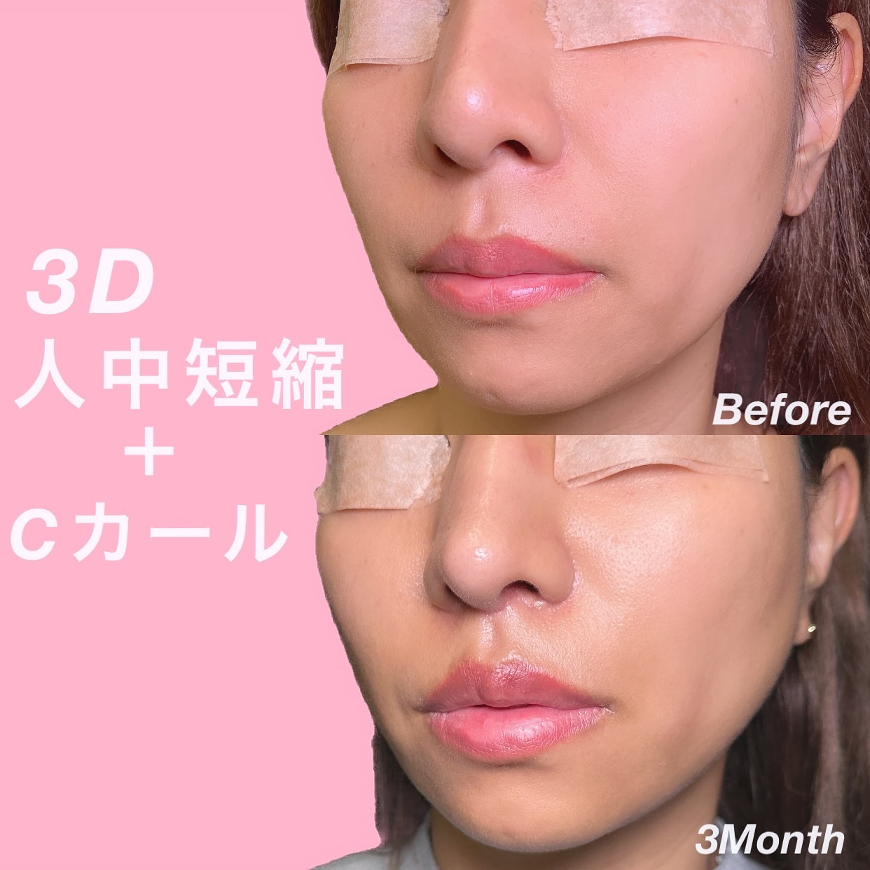 ３D人中短縮とCカール形成の症例写真