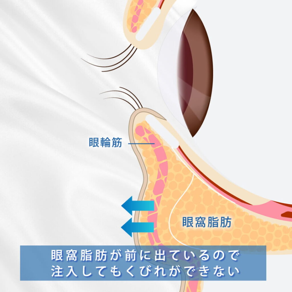 涙袋と眼窩脂肪の図解