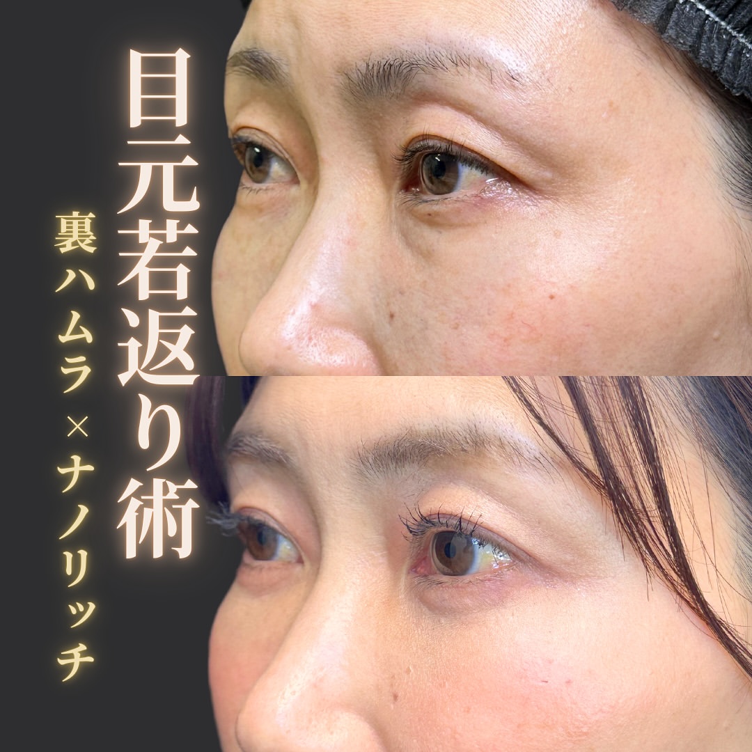 裏ハムラ法とナノリッチの症例 (1)