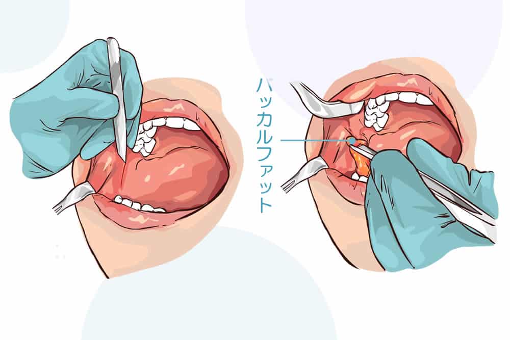 バッカルファットを除去している図解