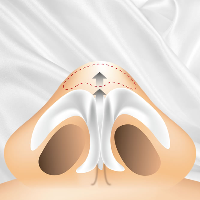 鼻尖形成のアイコン