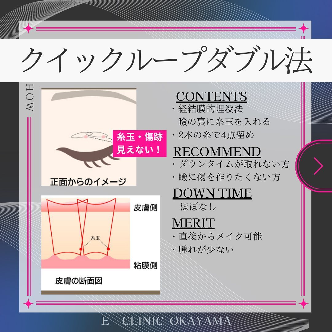 埋没法のクイックループダブルの解説の図解