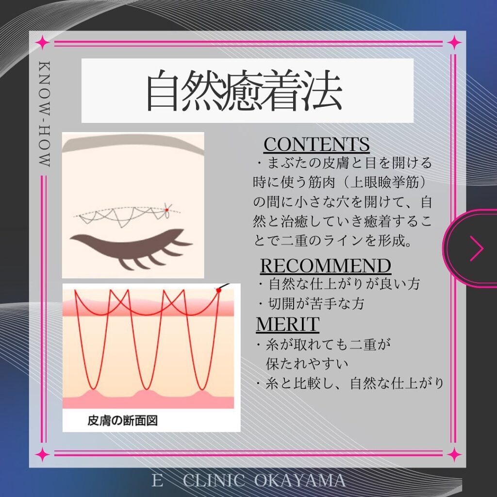 埋没法の自然癒着法のの解説の図解