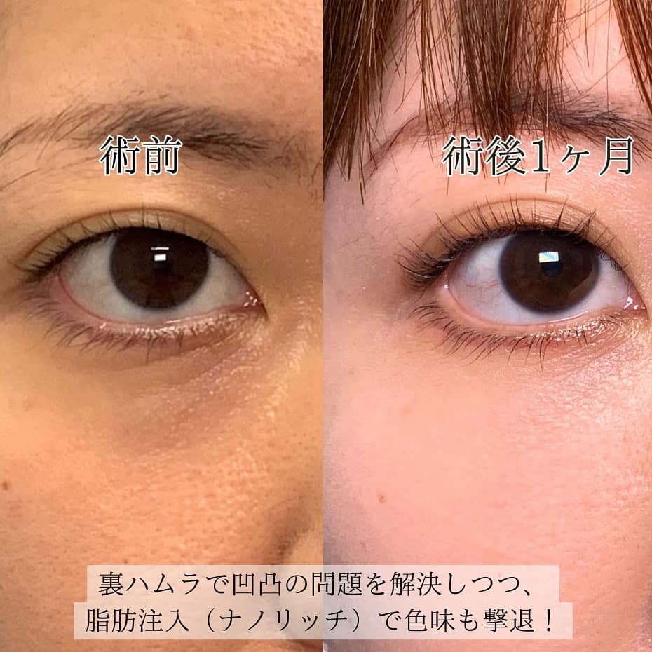 裏ハムラとナノリッチで脂肪注入をした1か月後の症例