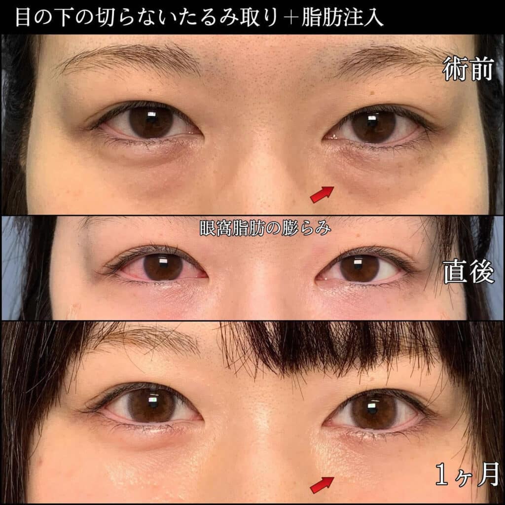 クマ取りの術後と１ヶ月後の症例