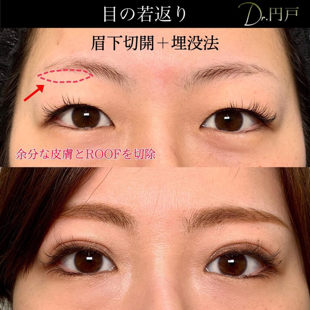 眉下切開と組み合わせた埋没法の症例