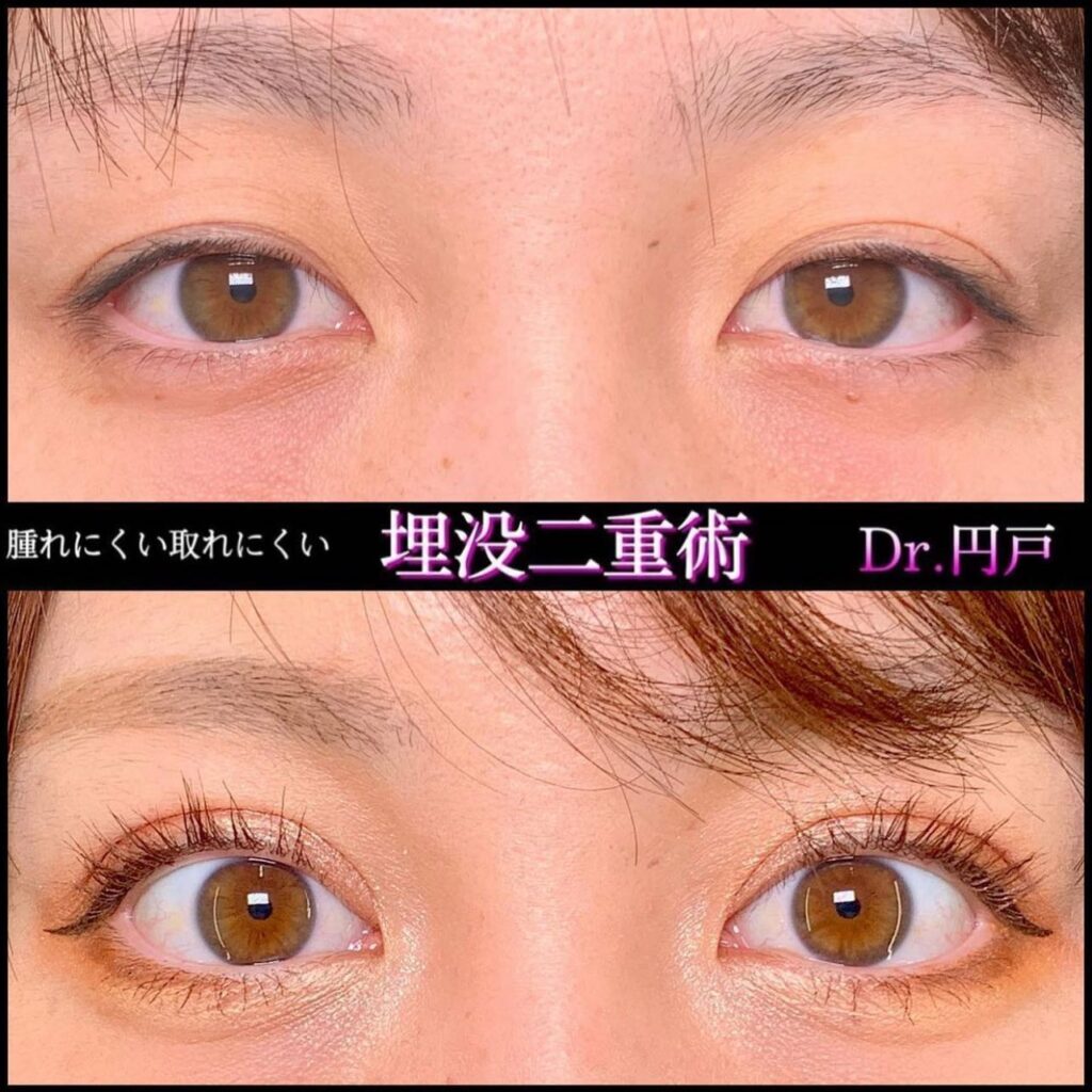 大きい目になった埋没法の症例