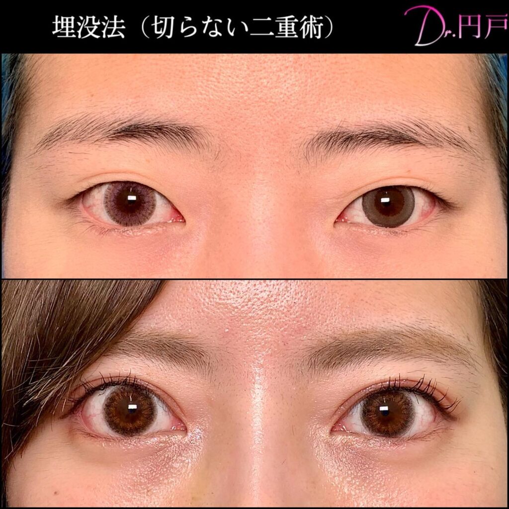 20代の埋没法の症例