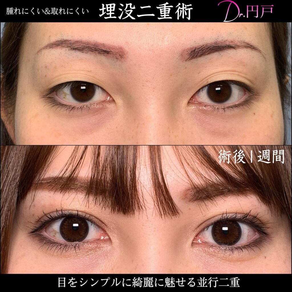 埋没法の1週間後の症例