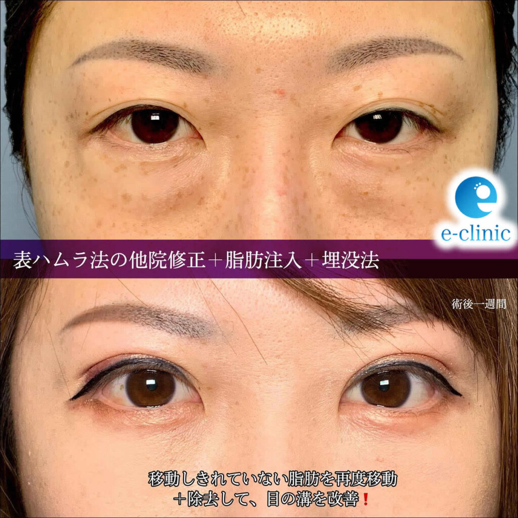 表ハムラ法で行ったクマ取りの修正手術の症例