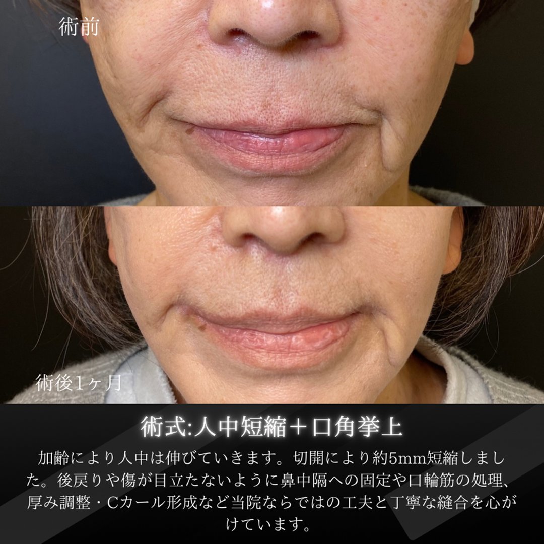 札幌院の人中短縮と口角挙上の１ヶ月後の症例写真