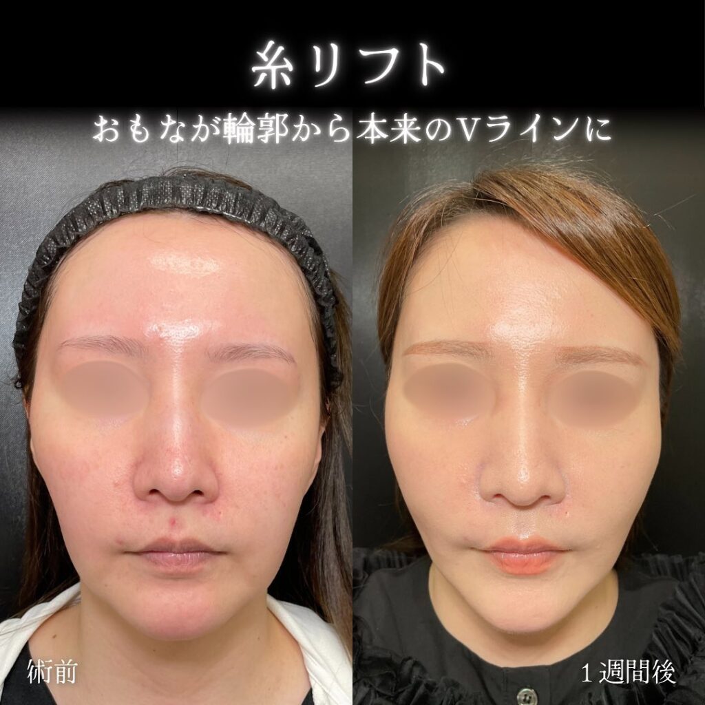 eクリニック札幌院の糸リフトの症例写真