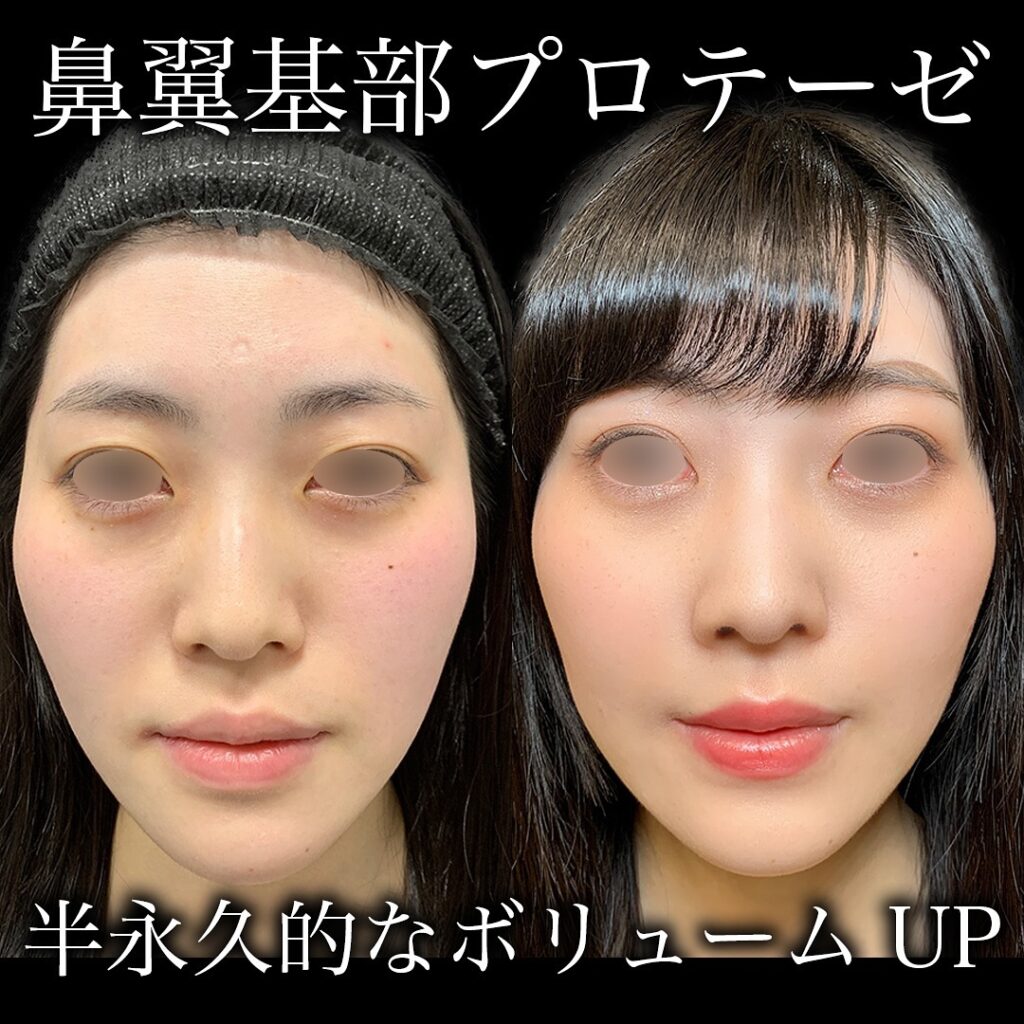 鼻のプロテーゼの症例写真