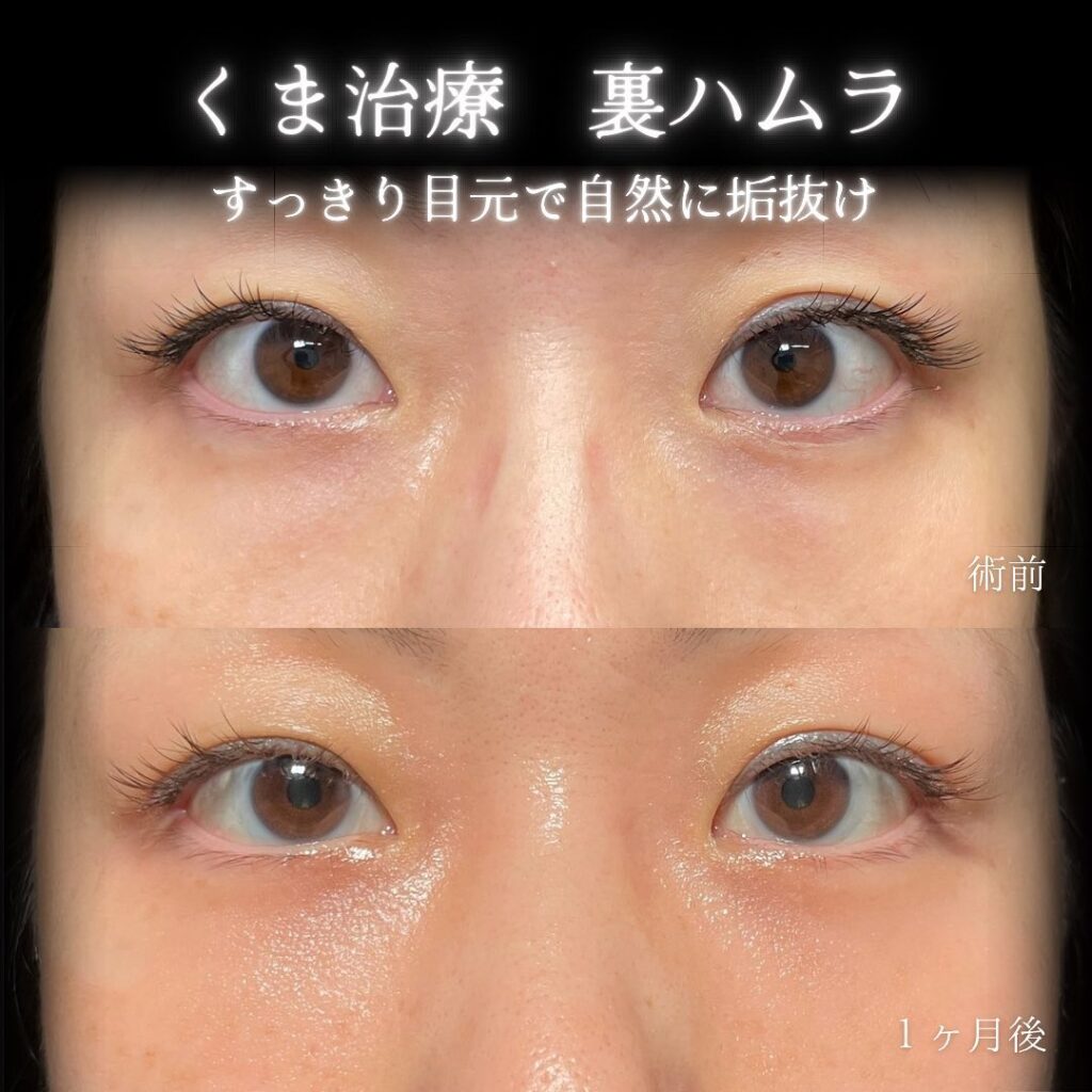 eクリニック札幌院の裏ハムラ症例画像(5)