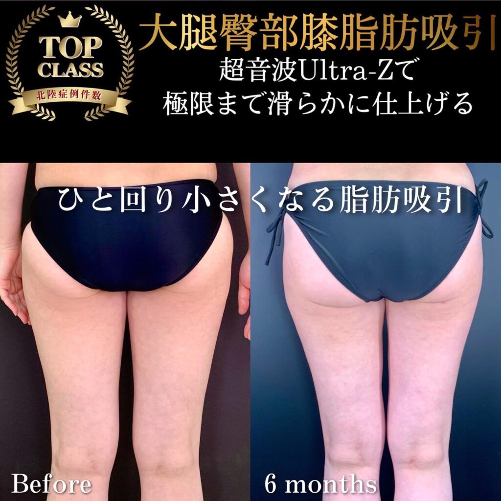 太ももの脂肪吸引の症例写真 (1)