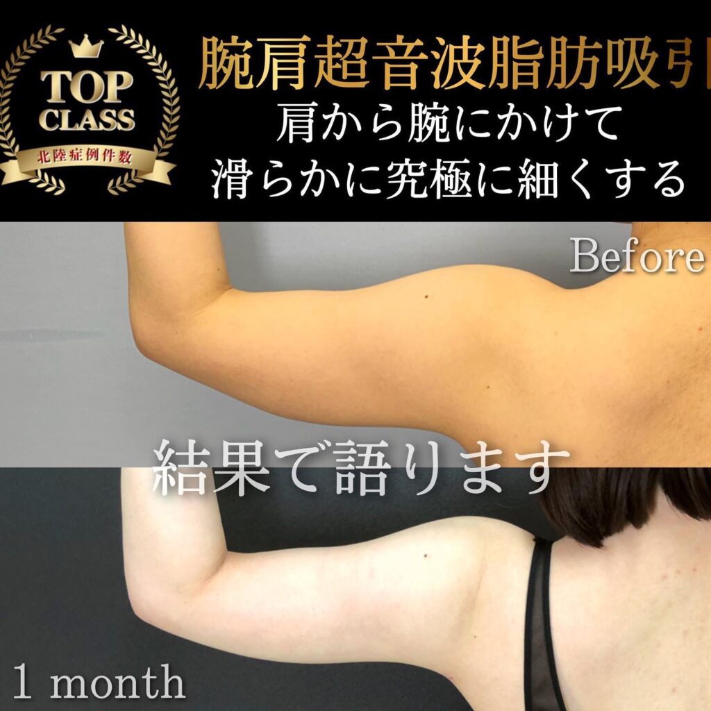 二の腕の脂肪吸引 (1)