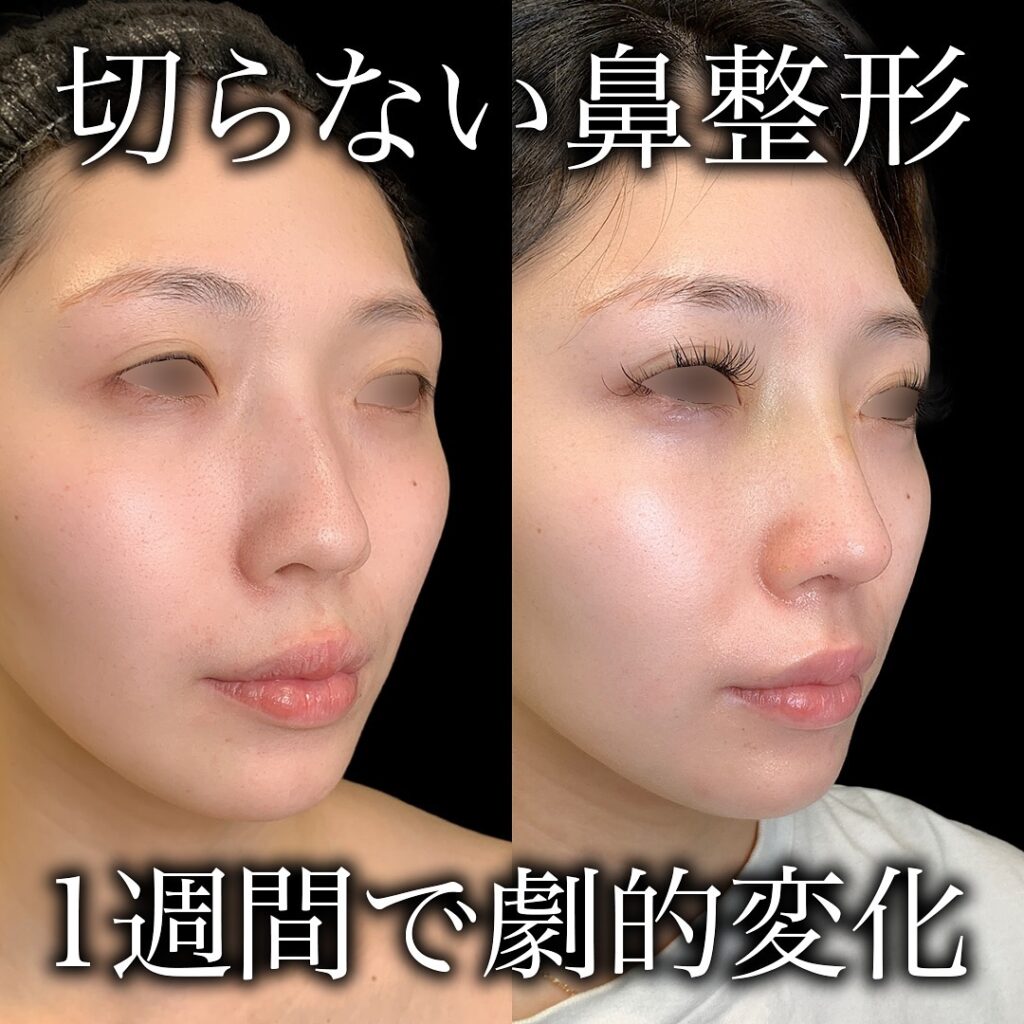 鼻尖形成と耳介軟骨移植と鼻のプロテーゼの症例写真