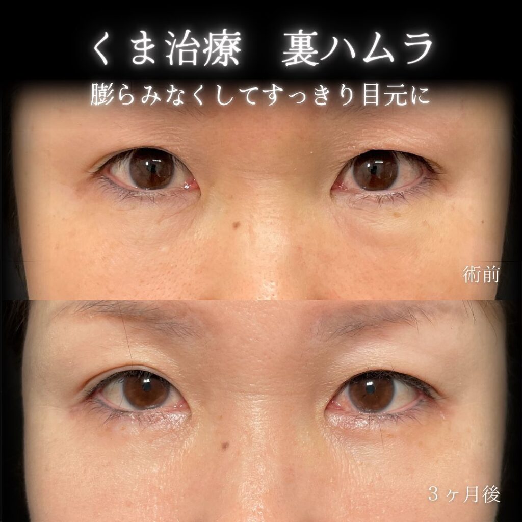 eクリニック札幌院の裏ハムラ症例画像(6)